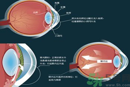 青光眼是什么？青光眼癥狀有什么？