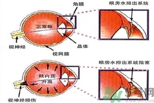 青光眼的發(fā)病因素是什么？青光眼的并發(fā)癥有哪些？