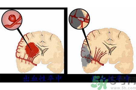 腦出血的發(fā)病因素是什么？腦出血的并發(fā)癥有哪些？