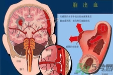 腦出血的發(fā)病因素是什么？腦出血的并發(fā)癥有哪些？