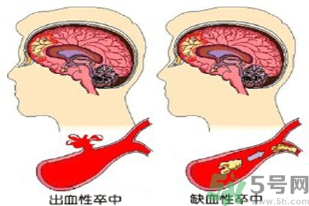 腦出血的治療方法是什么？腦出血可以用哪些藥物治療？