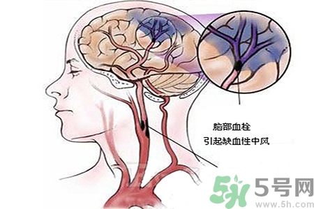 腦出血的治療方法是什么？腦出血可以用哪些藥物治療？