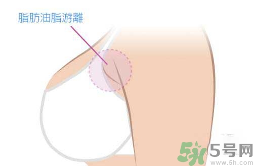 副乳是什么？副乳的危害