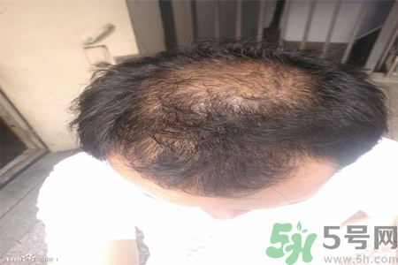 脫發(fā)的措施有什么？脫發(fā)的注意飲食有哪些？