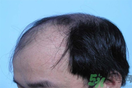 脫發(fā)的措施有什么？脫發(fā)的注意飲食有哪些？