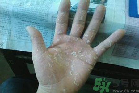 引起手足癬的主要原因？手足癬會(huì)引發(fā)什么疾?。?></p><h3>手足癬會(huì)引發(fā)什么疾病</h3><p>手足癬除了其臨床表現(xiàn)外，還可引起其他疾病。本病可引起丹毒、急性淋巴管炎和急性蜂窩組織炎，故應(yīng)引起臨床醫(yī)生和患者的高度重視。</p> </div>
<div align=