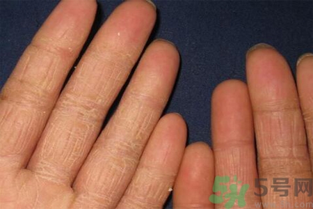 手足癬的治療方法？治療手足癬可以用什么藥？