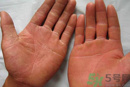 手足癬的治療方法？治療手足癬可以用什么藥？