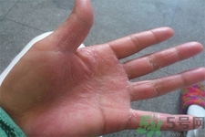 手足癬的易發(fā)人群有哪些？如何預(yù)防手足癬？