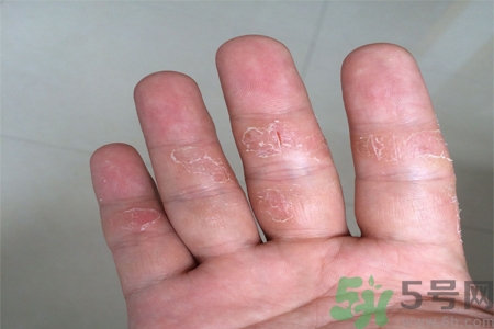 手足癬的易發(fā)人群有哪些？如何預(yù)防手足癬？