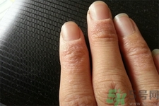 手足癬會(huì)傳染嗎？手足癬的傳播途徑有哪些？