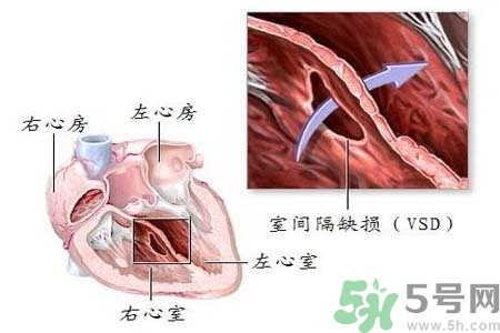 先天性心臟病是什么？先天性心臟病的癥狀有哪些？