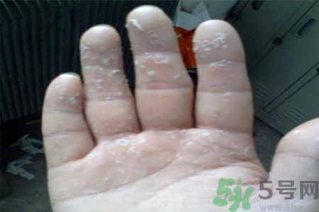 手足癬的易發(fā)人群有哪些？如何預(yù)防手足癬？