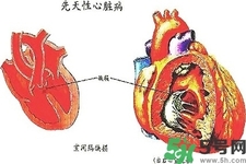 心臟病的癥狀是什么？心臟病的種類有哪些？