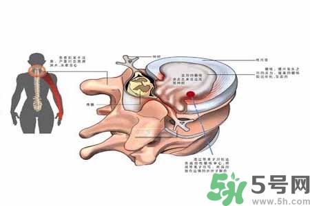 為什么年輕人容易得頸椎??？頸椎病嚴(yán)重的癥狀有哪些？