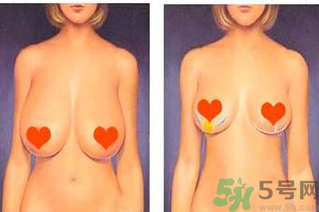 ?女性乳房下垂的原因是什么？女性乳房下垂的分類有哪些？