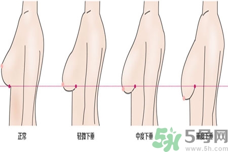 ?女性乳房下垂的原因是什么？女性乳房下垂的分類有哪些？