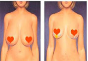 ?女性乳房下垂的原因是什么？女性乳房下垂的分類有哪些？