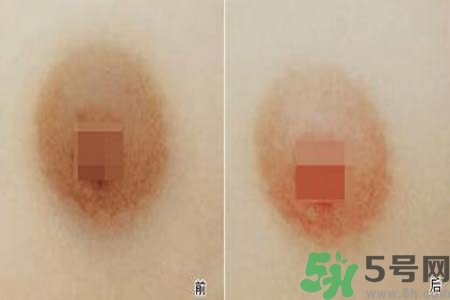 乳頭發(fā)黑怎么辦？怎么樣可以使乳頭變白？