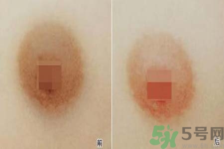 乳頭發(fā)黑是怎么回事？乳頭發(fā)黑是什么原因？