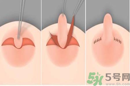乳頭內(nèi)陷怎么回事？乳頭內(nèi)陷的原因是什么？