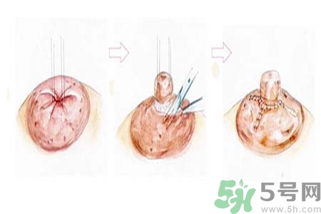 乳頭內(nèi)陷怎么回事？乳頭內(nèi)陷的原因是什么？