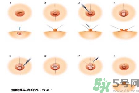 乳頭內(nèi)陷怎么回事？乳頭內(nèi)陷的原因是什么？