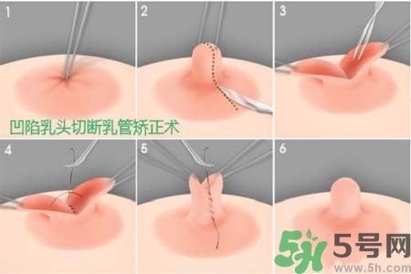 乳頭內(nèi)陷怎么辦？乳頭內(nèi)陷的癥狀有哪些？