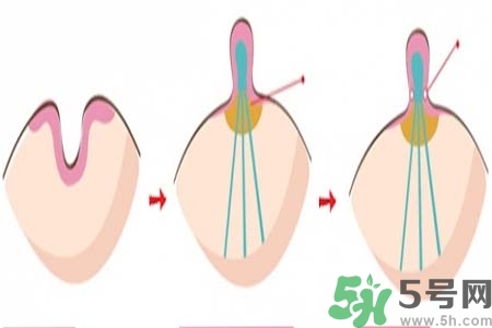 乳頭內(nèi)陷怎么辦？乳頭內(nèi)陷的癥狀有哪些？