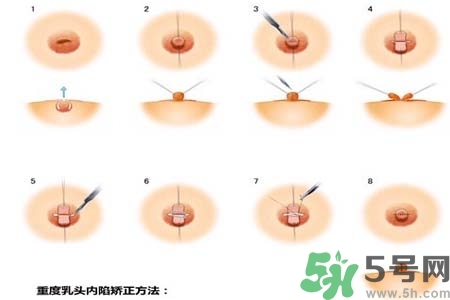 乳頭內(nèi)陷怎么辦？乳頭內(nèi)陷的癥狀有哪些？
