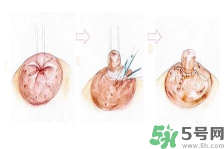 乳頭內(nèi)陷怎么辦？乳頭內(nèi)陷的癥狀有哪些？