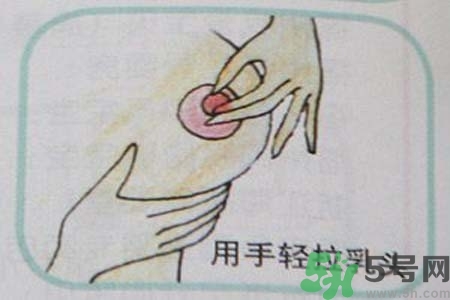 乳頭內(nèi)陷怎么辦？乳頭內(nèi)陷的癥狀有哪些？