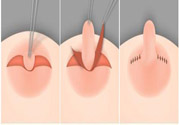 乳頭內(nèi)陷怎么辦？乳頭內(nèi)陷的癥狀有哪些？