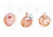 乳頭內(nèi)陷矯正需注意什么？乳頭內(nèi)陷如何預(yù)防？