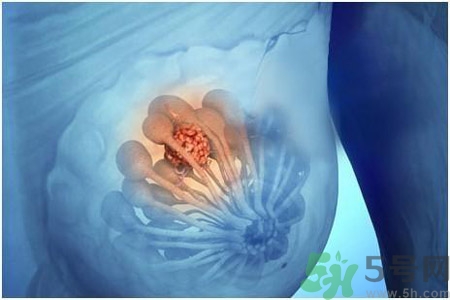 乳房屋硬塊有疼痛感怎么回事？乳房屋硬塊有疼痛感怎么辦？