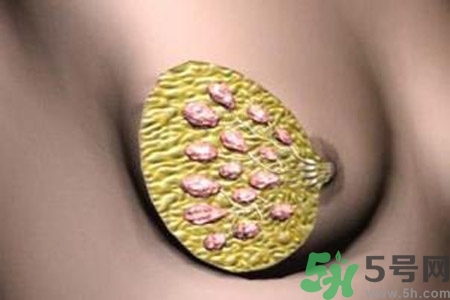 乳腺增生鈣化是什么？乳腺鈣化的癥狀有哪些？
