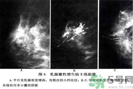 乳腺增生鈣化是什么？乳腺鈣化的癥狀有哪些？