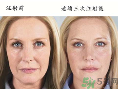 3D液態(tài)拉皮多少錢？3D液態(tài)拉皮后多久見效？