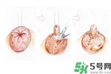 乳頭內(nèi)陷怎么矯正？乳頭內(nèi)陷矯正方法是什么？