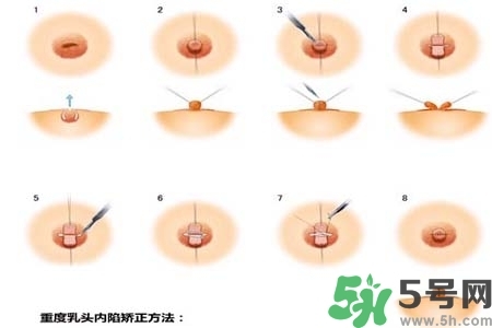 乳頭內(nèi)陷怎么矯正？乳頭內(nèi)陷矯正方法是什么？