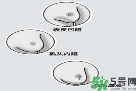 乳頭內(nèi)陷怎么矯正？乳頭內(nèi)陷矯正方法是什么？