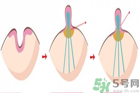 乳頭內(nèi)陷矯正需注意什么？乳頭內(nèi)陷如何預(yù)防？