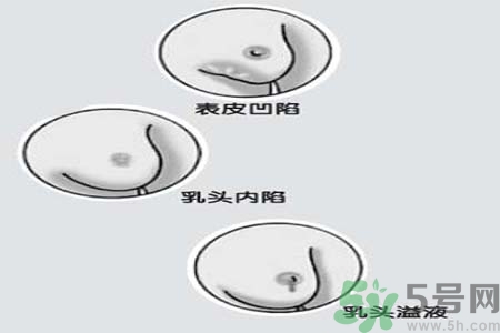 乳頭內(nèi)陷矯正需注意什么？乳頭內(nèi)陷如何預(yù)防？
