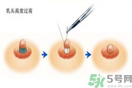 乳頭內(nèi)陷能不能喂奶？乳頭凹陷怎樣哺乳？