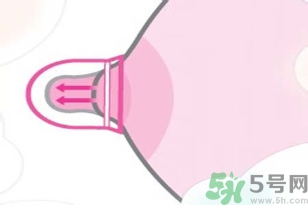 乳頭內(nèi)陷可以拔罐嗎？乳頭內(nèi)陷需要手術治療嗎？