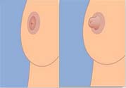乳頭內(nèi)陷可以用吸奶器嗎？乳頭內(nèi)陷能不能用吸奶器？