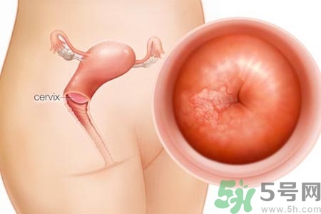 陰道松弛是什么？陰道松弛的癥狀有哪些？