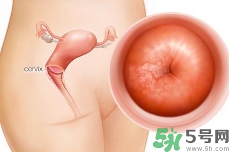 陰道出血和什么有關？陰道出血的應急措施有哪些？