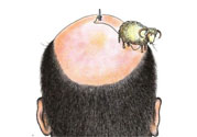 禿頂會(huì)遺傳嗎？治療禿頂?shù)姆椒ㄊ鞘裁矗?><p><strong>禿頂會(huì)遺傳嗎？治療禿頂?shù)姆椒ㄊ鞘裁矗?/strong></p></a></li> </ul>
</div>
<div   id=