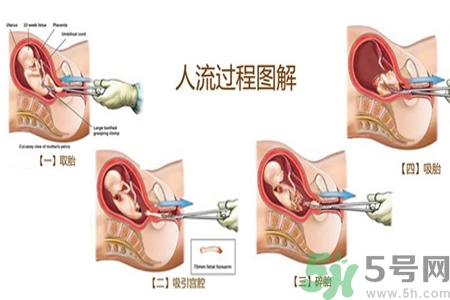 人工流產(chǎn)后多久可以再次懷孕？流產(chǎn)后需要注意什么？